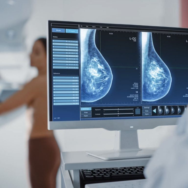 Mammographie : pour qui, pour quoi et comment ?